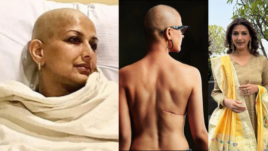 Sonali bendre cancer recovery