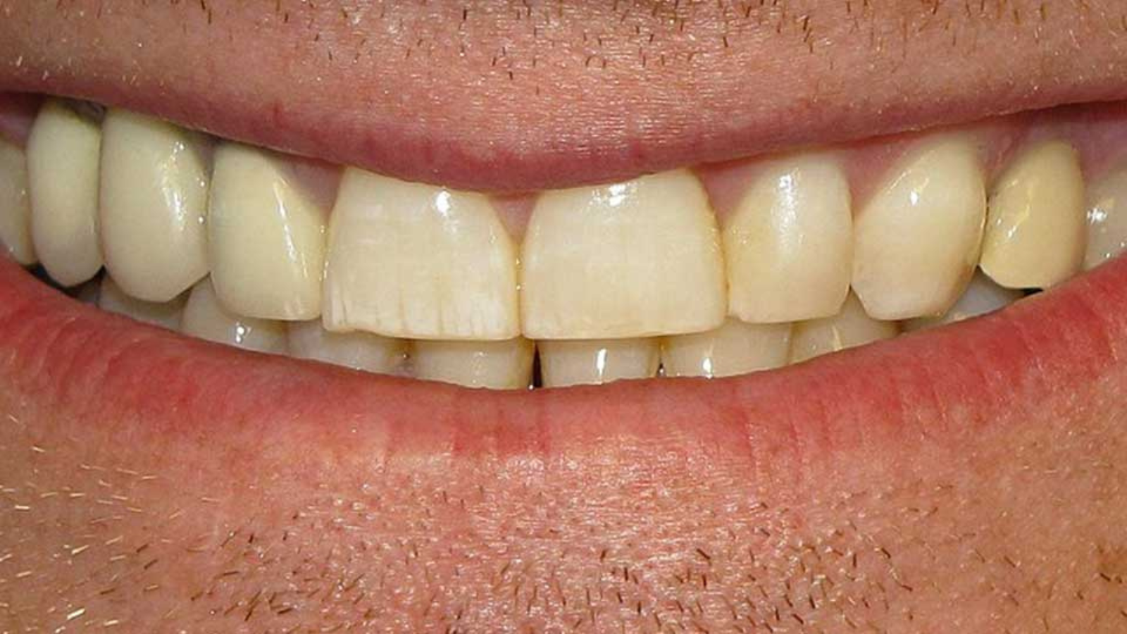 Teeth Whitening Home Remedy